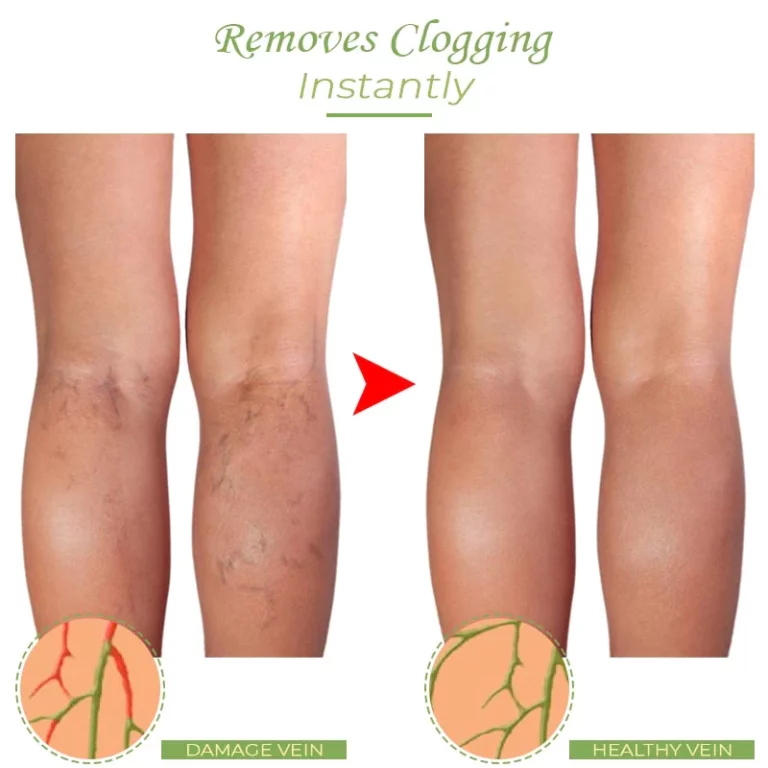 VeinCare VaricoseVein Healing Cream