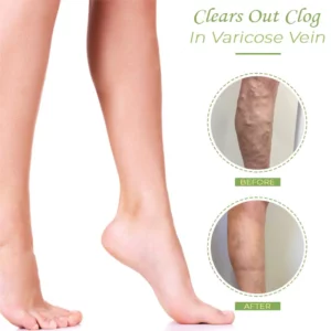 VeinCare VaricoseVein Healing Cream