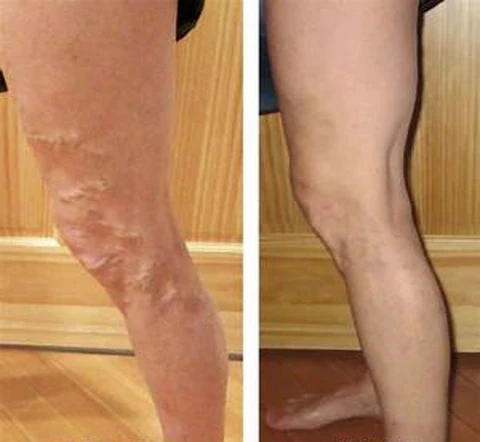 Raura™ Varicose Veins Treatment Cream